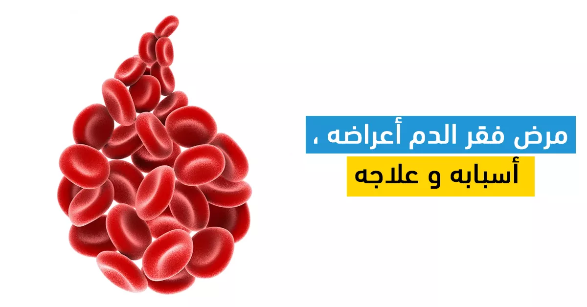 مرض فقر الدم أعراضه ، أسبابه و علاجه